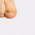 Schimmel van nagels op de grote teen met als oplossing de nail-cure drops van By La Nature - dermatomycose en onychomycose, schimmelinfectie macrofoto.