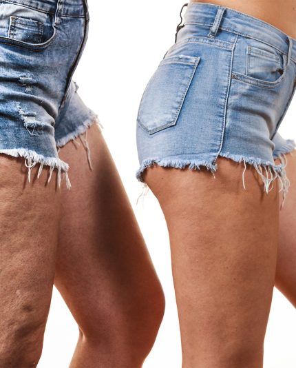Vergelijking van vrouwelijke benen dijen met en zonder cellulitis. Met gebruik van Révvi anti-cellulite crème , geïsoleerd op een witte achtergrond