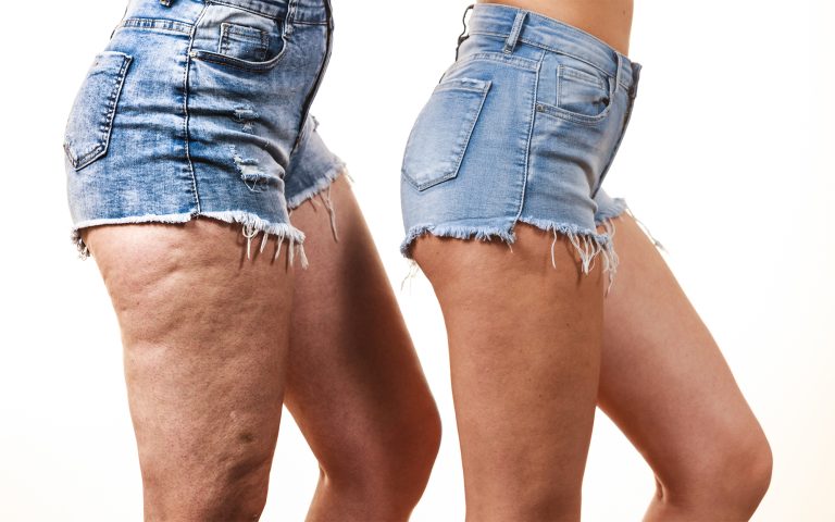 Vergelijking van vrouwelijke benen dijen met en zonder cellulitis. Met gebruik van Révvi anti-cellulite crème , geïsoleerd op een witte achtergrond