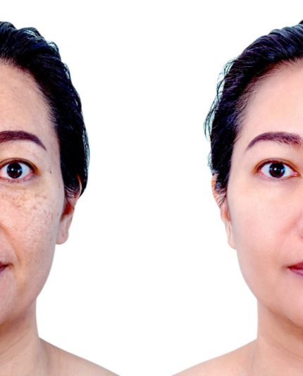 Afbeelding voor en na pigmentatie gezichtsbehandelingen Blue Sage Shop - vrouw heeft filsuisse withening gebruikt tegen haar pigmentvlekken