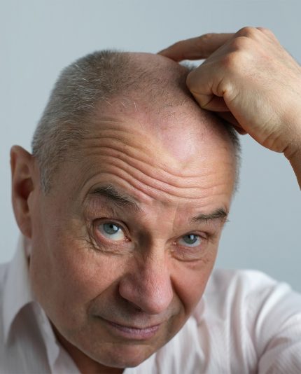 close-up oude kale charismatische volwassen man die zijn haar van het hoofd laat vallen, patiënt met alopecia in haargroeikliniek, onderwerp van haarverlies bij mannen, selectieve focus. Anti-verouderingsbehandelingen voor kalende mannen. Haargroei stimulatie, haargroei stimuleren met booster van Révvi