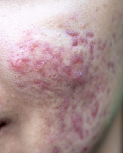 Achtergronden van huidlaesies veroorzaakt door acne op het gezicht, moet anti acne producten gebruiken van Blue Sage shop huidverbetering