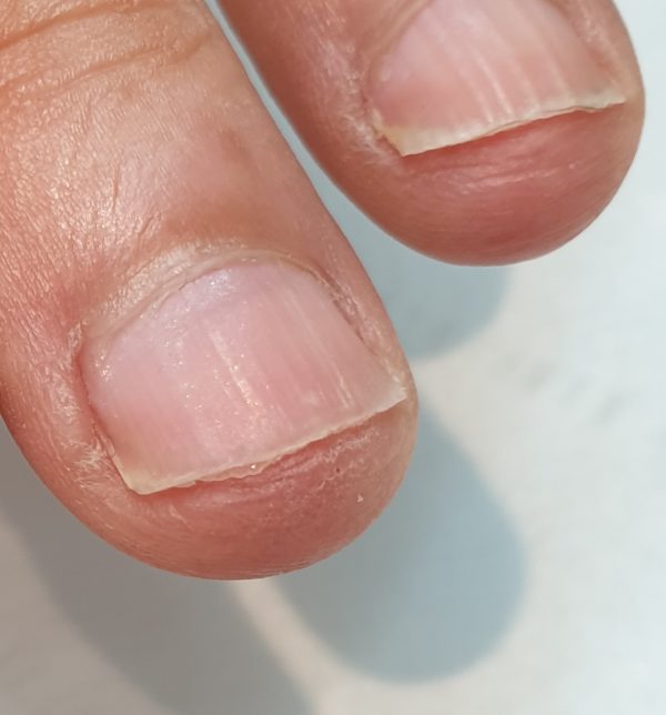 Foto van twee vingers met de nagels van een nagelbijters voor de antinagelbijtkuur van Blue Sage. Model voor de opleiding nagelstyling - antinagelbijtkuur