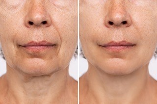 Close-up van een voor en na foto van een vrouw haar gezicht, resultaten na 3 maanden met het gebruiken van de collageen van Blue Sage